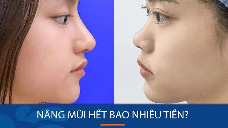 Nâng mũi hết bao nhiêu tiền?