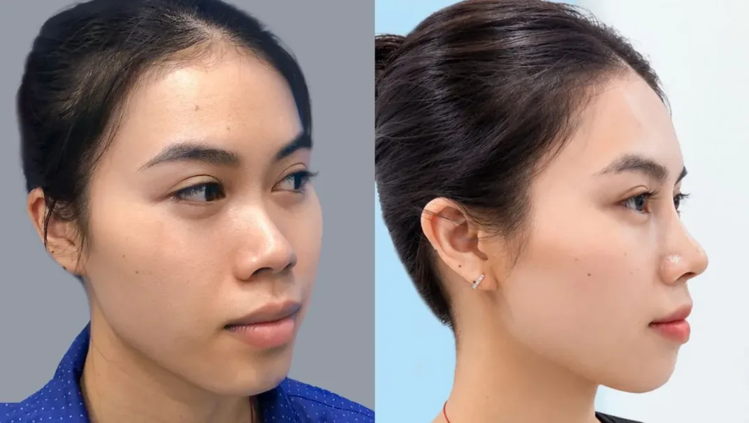 Những tiêu chí cần kiểm tra trước khi lựa chọn cơ sở nâng mũi